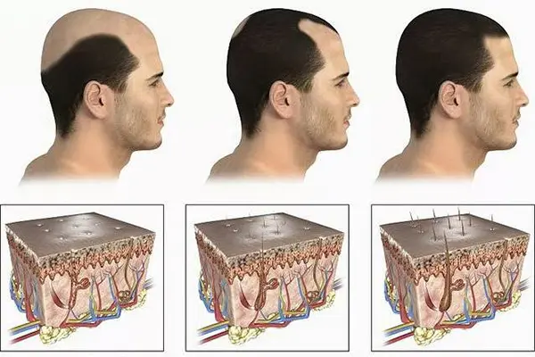 Minoxidil